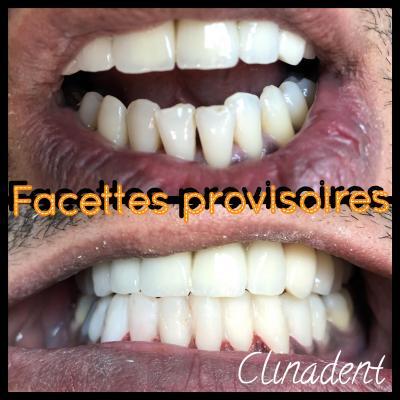 Réalisation de facettes dentaires au centre Clinadent Bagnolet