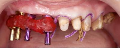 Pose implant dentaire Bagnolet